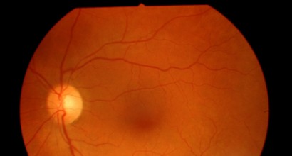 Ֆրեզնոյից բժիշկների թիմը Հայաստան է բերել 4 թվային խցիկ աչքի ցանցաթաղանթի հետազոտության համար