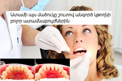 Ատամի այս մածուկը շուտով անգործ կթողնի բոլոր ատամնաբույժներին