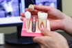 Ինչո՞ւ է ատամների իմպլանտացիան այդքան պահանջված